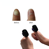 Finger Toe Rehabilitation Nail Fungus Laser Treatment hine For Onychomycosis