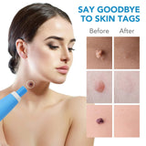 2 In 1 Automatic Kit Miniature Skin Tag Adult Mole Stains Wart Remover Facial Care Beauty Tool
