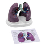 (English instructions) Anatomical Pathological Lung Model Normal and Pathological Lung Anatomy Model for Teaching Research Clinical Settings