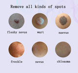 Removing nevi, spot nevi, spot spot scanning machine, beauty spot nevi pen, spot scanning pen, spot removal instrument, beauty s
