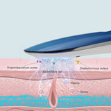 Acne Removal LED Plasma Beauty Device Whitening and Brightening Ozone Cold Plasma Beauty Device Multifunctional Facial Skin Care