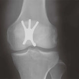 Professional New Patellar Fixator Titanium Internal Fixation for Hospitals Medical Suppliers