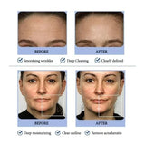 6 in 1 Home Skin Peel Dermabrasion Face Steamer Ultrasound Hot Cold Oxygen Spray Facial Spa Microdermabrasion Hydra D