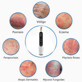 308nm UVB Lamp | Professional LED Light Therapy  for Vitiligo & Psoriasis
