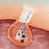Suction Blackhead Artifact Small Bubble Blackhead Instrument Household Beauty Instrument Pore Cleaning Instrument