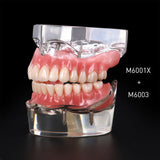 Dental Implant Restoration Teeth Model Removable Bridge Denture Demo Disease Teeth Model With Restoration Bridge Teaching Study