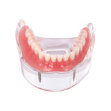 Dental Implant Restoration Teeth Model Removable Bridge Denture Demo Disease Teeth Model With Restoration Bridge Teaching Study