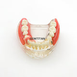 Dental Implant Restoration Teeth Model Removable Bridge Denture Teaching research model