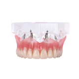 Dental Implant Restoration Teeth Model Removable Bridge Denture Demo Disease Teeth Model With Restoration Bridge Teaching Study