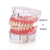 Dental Implant Restoration Teeth Model Removable Bridge Denture Demo Disease Teeth Model With Restoration Bridge Teaching Study