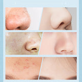 Pore Cleaner Blackhead Remover Face Skin Care Suction Black Head Black Dots Pimples Removal Deep Cleaning Tool