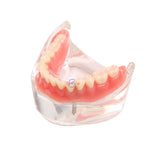1pcs Dental Over denture Inferior Teeth Model With 2 Implant Demo Teeth Study Model Practical Dental Model Accessories