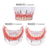 Dental Implant Restoration Teeth Model Removable Bridge Denture Demo Disease Teeth Model With Restoration Bridge Teaching Study