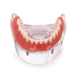 Dental Implant Restoration Teeth Model Removable Bridge Denture Demo Disease Teeth Model With Restoration Bridge Teaching Study