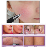High Frequency Spider Veins Removal Machine Spa Salon Blood Redness Vascular Remover Beauty Equipment Anti Redness Machine