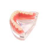 1pcs Dental Over denture Inferior Teeth Model With 2 Implant Demo Teeth Study Model Practical Dental Model Accessories