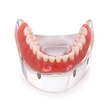 Dental Implant Restoration Teeth Model Removable Bridge Denture Demo Disease Teeth Model With Restoration Bridge Teaching Study