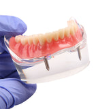 1pcs Dental Over denture Inferior Teeth Model With 2 Implant Demo Teeth Study Model Practical Dental Model Accessories