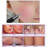 High Frequency Remove Facial Thread Veins Device Beauty Machine Salon Equipment For Facial Vein Red Blood Vessel Removal