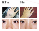 NEW Neatcell Picosecond Pen Blue Light Therapy Laser Plasma Pen Scar Mole Freckle Tattoo Tag Dark Spot Removal Machine USB